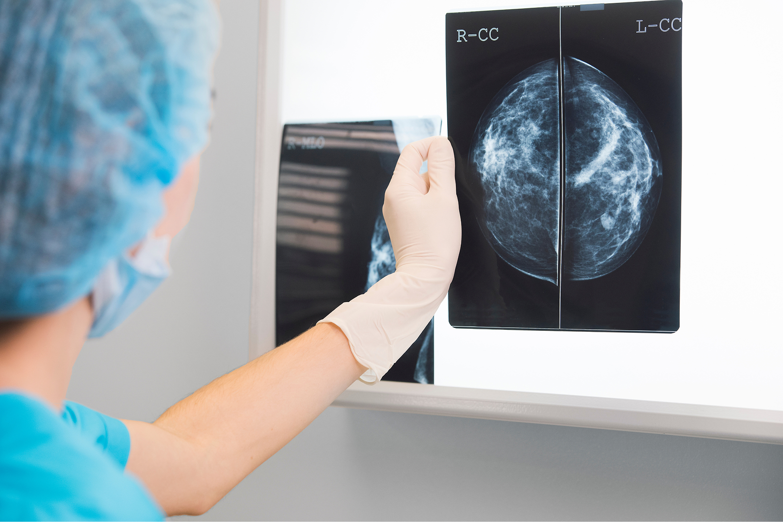 Eine Person in medizinischer Kleidung hält eine Mammografie-Aufnahme gegen einen Lichtkasten.