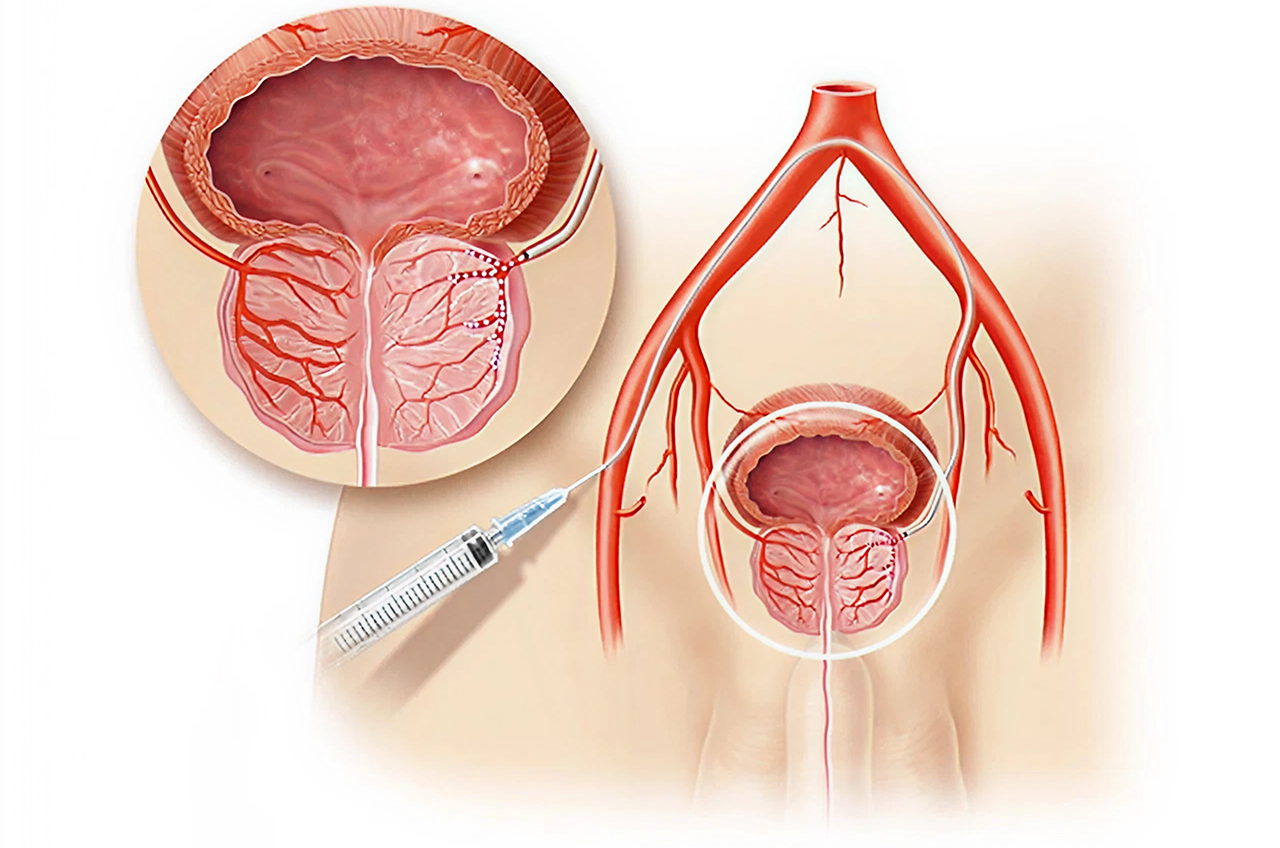 Illustrative Abbildung einer Prostata-Embolisation mit vergrößertem Ausschnitt.